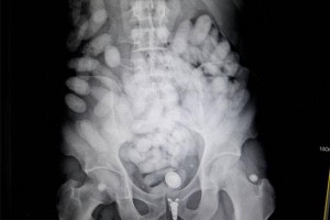 X-ray maag smokkelaar
